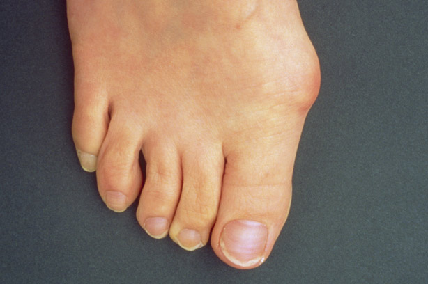 Bunion
