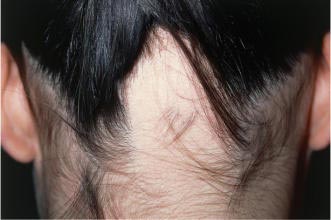 Alopecia