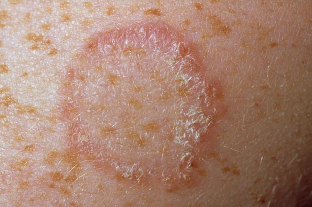 Fungal Skin Infections Common Treatment & Care