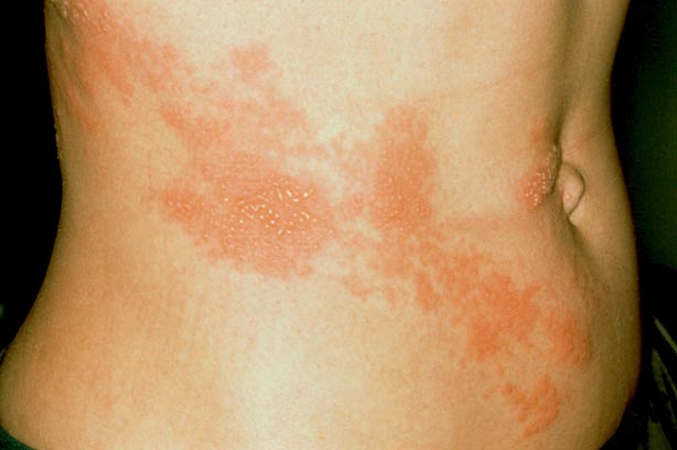 Is shingles contagious for adults?