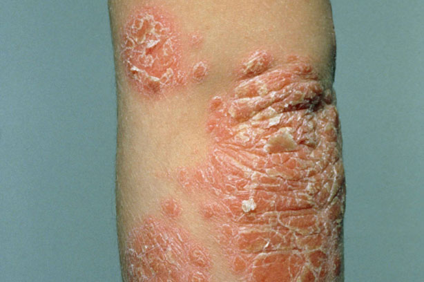 child psoriasis