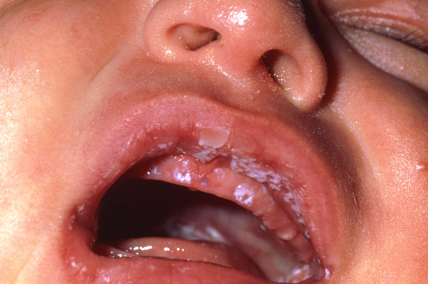Baby Tongue Thrush