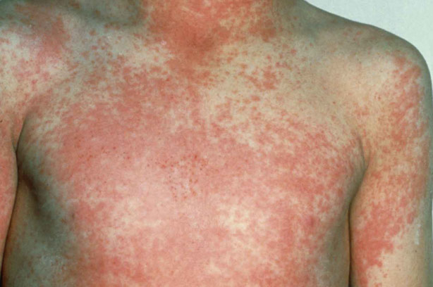 symptoms of scarlet fever #10