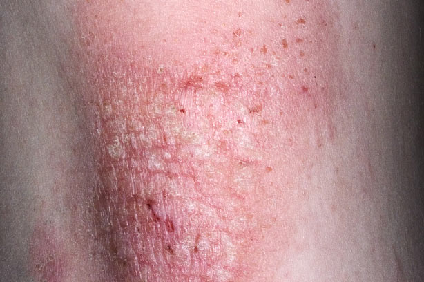 adult eczema