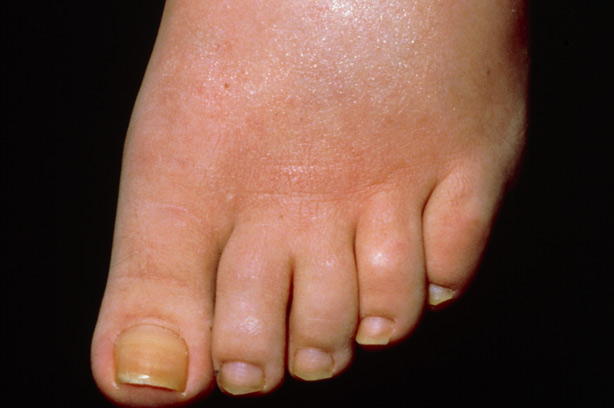 Oedema Oedema