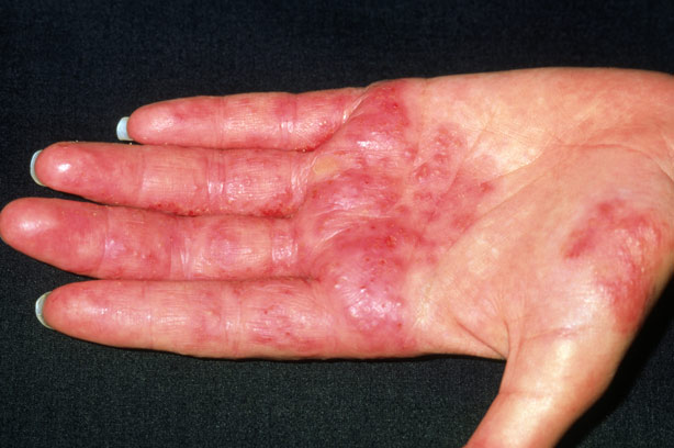 Contact dermatitis: MedlinePlus Medical Encyclopedia