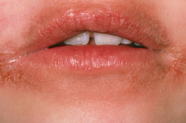 Perioral Dermatitis Men