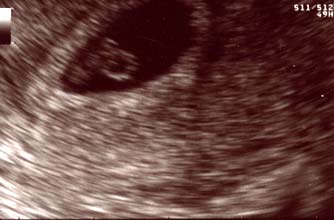 Anna's 7 week scan