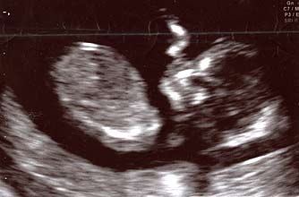 Baby 12-week scan Baby 12-week scan
