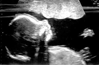 Anna's pregnancy diary - ultrasound scan