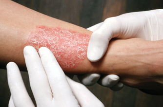 Psoriasis