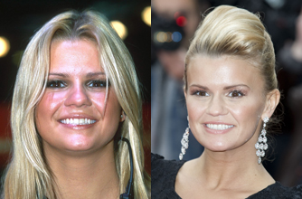 Kerry Katona, teeth Kerry Katona, teeth
