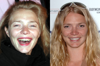 Jodie Kidd, teeth Jodie Kidd, teeth