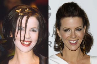 Kate Beckinsale, teeth Kate Beckinsale, teeth