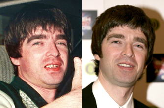 Noel Gallagher, teeth