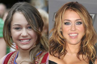 Miley Cyrus Teeth Before and After [Fake Tooth Surgery] 