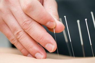 Acupuncture, fertility Acupuncture, fertility