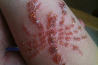 'My son is scarred for life after holiday horror tattoo'