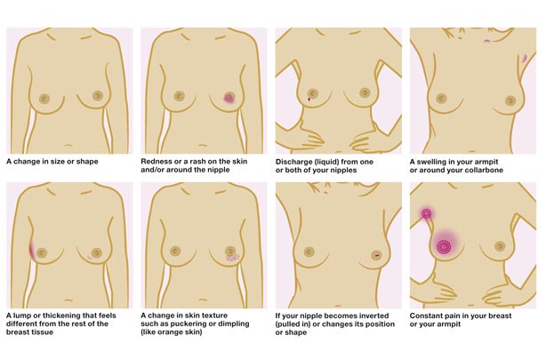 Look out for changes in your breasts