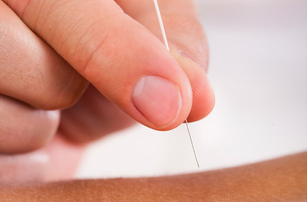 Acupuncture Acupuncture