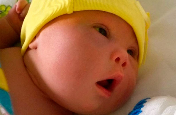 Baby Leo, Downs Syndrome