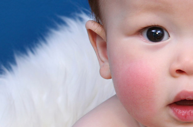 Slapped cheek syndrome