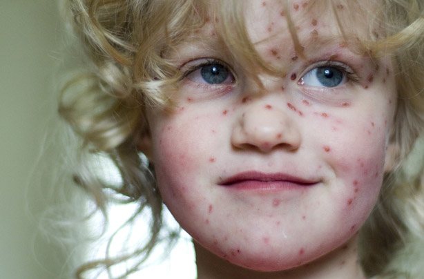 Little girl with chicken pox