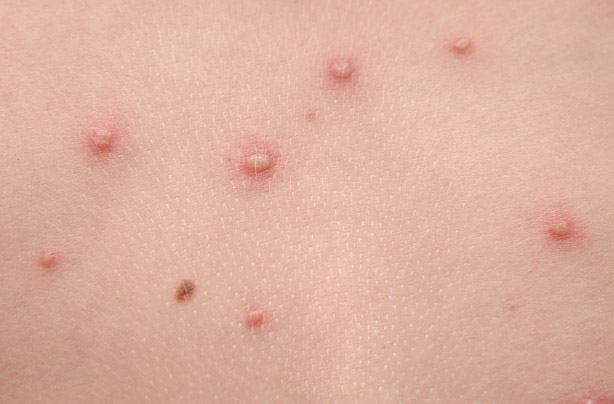 What are the symptoms of chickenpox?