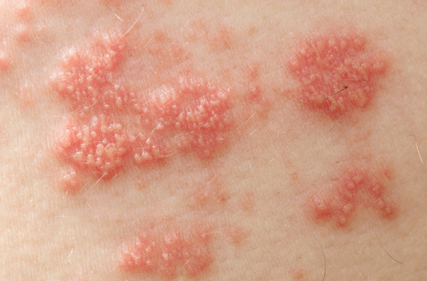 Shingles
