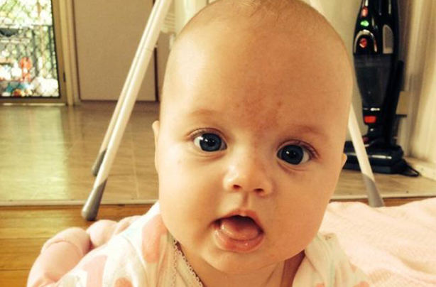 Ocea Varney Beckwith-Wiedemann Syndrome