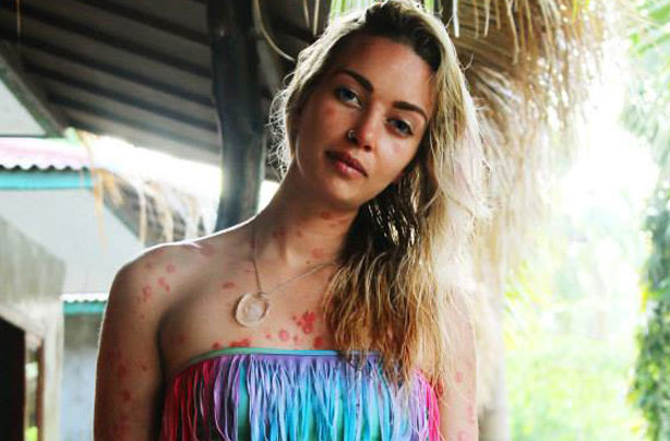 Giorgia Lanuzza psoriasis story