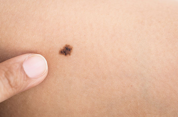 Moles, skin cancer risk, moles on right arm