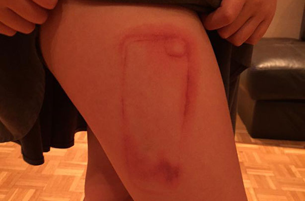 phone case burn