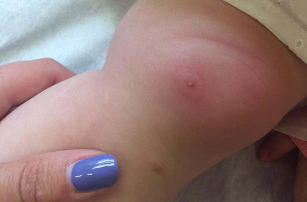 Mandy Osmack lyme disease warning post