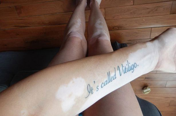 Tiffany Grant It's Called Vitiligo tattoo