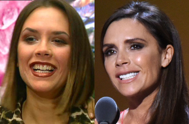 Victoria Beckham's teeth Victoria Beckham's teeth