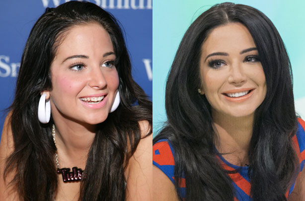 Tulisa's teeth Tulisa's teeth