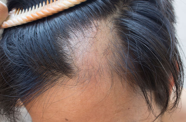 research paper on alopecia areata research paper on alopecia areata