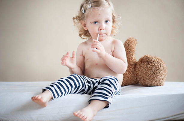 Chickenpox