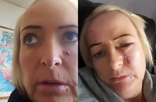 Lorraine Henderson skin cancer selfie