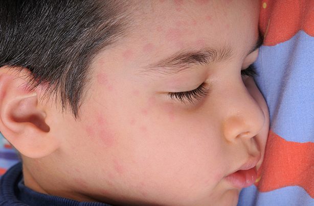 first signs of measles in adults