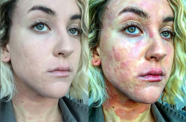 Psoriasis selfie, Ciena Rae Nelson