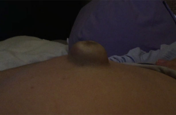Pregnancy hernia