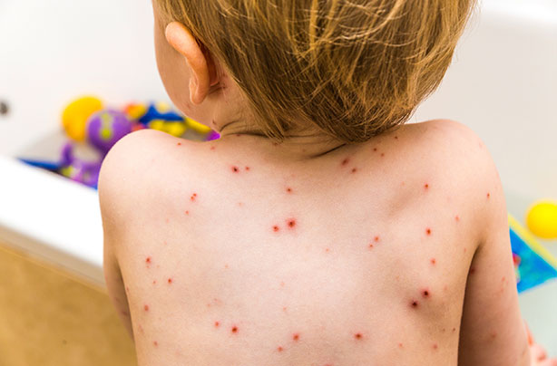Chicken pox
