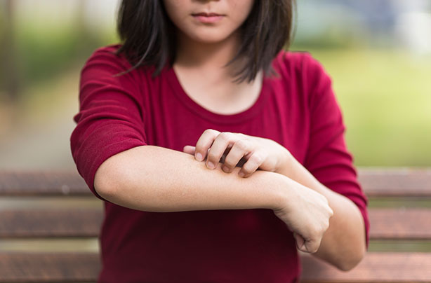 Eczema