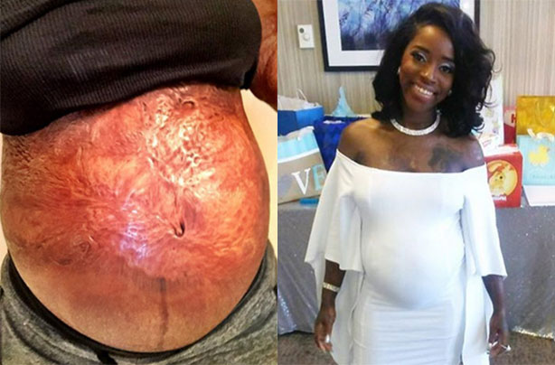 Burn victim shares pregnany photos