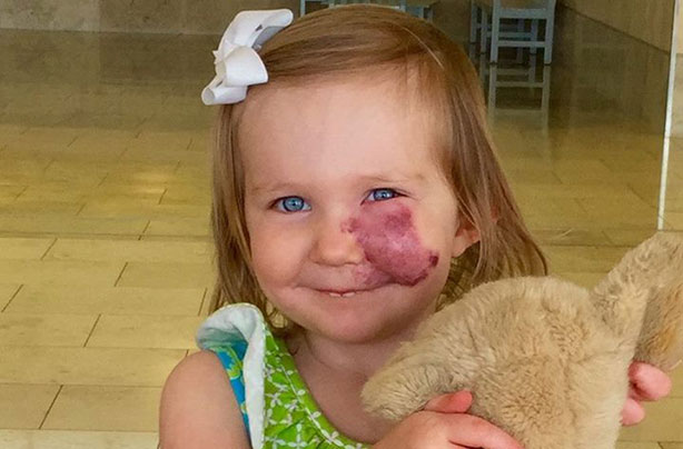 Girl with birthmark