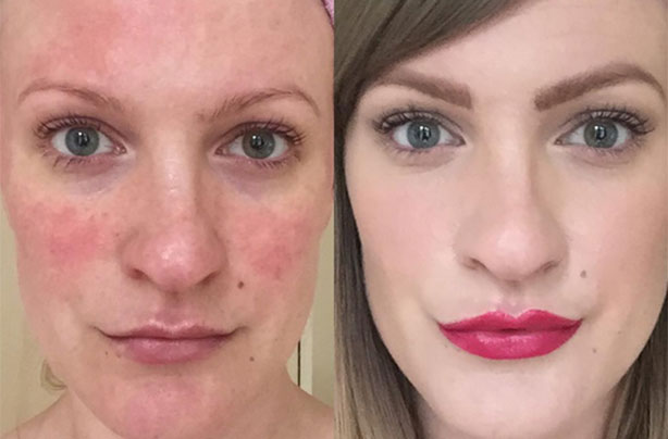 Lex Gillies beauty blogger rosacea