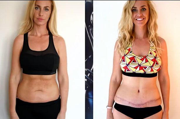 Josie Gibson tummy tuck