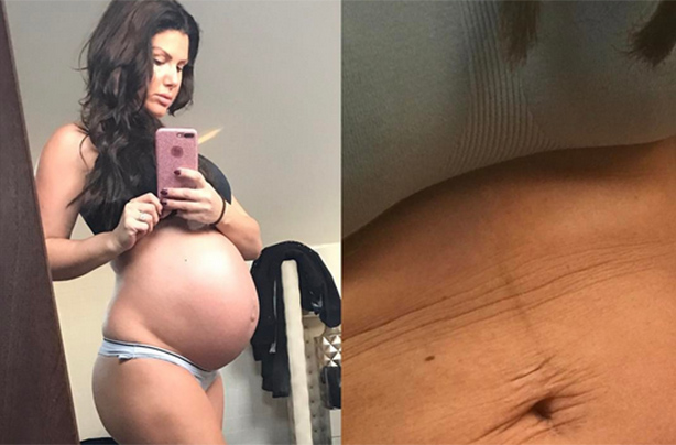 rebekah vardy stretch marks